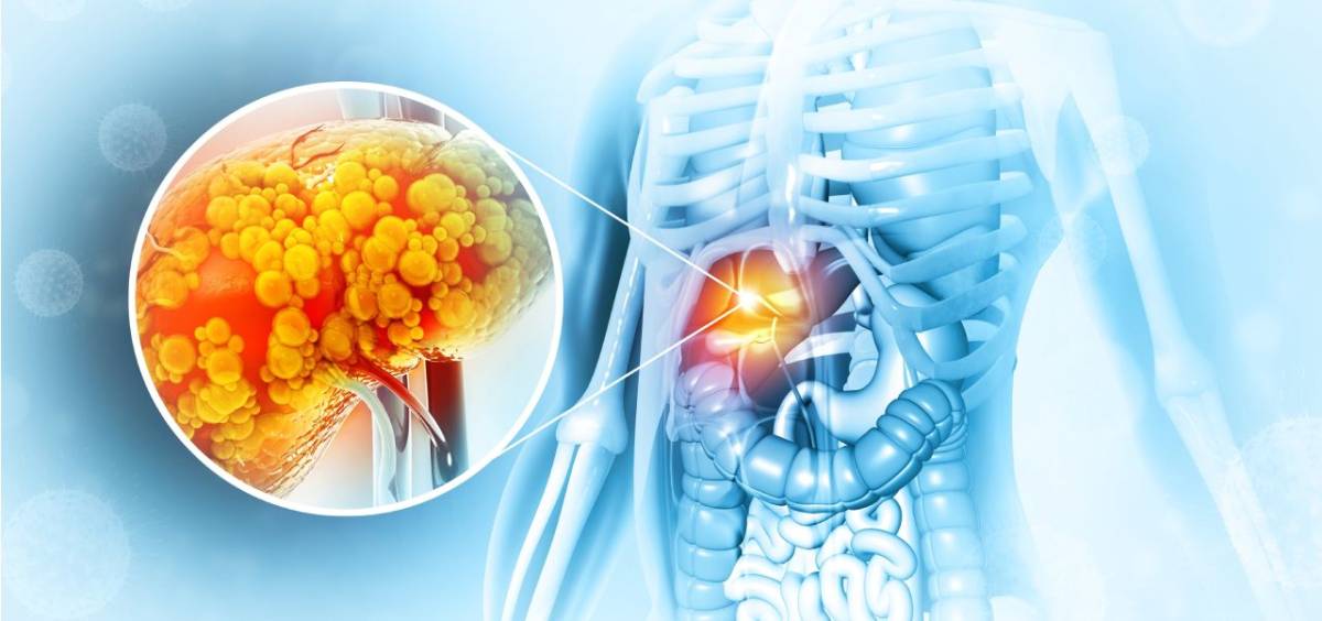 Der Zusammenhang zwischen Fettleber und Ihrer Ernährung: Was Sie wissen müssen
